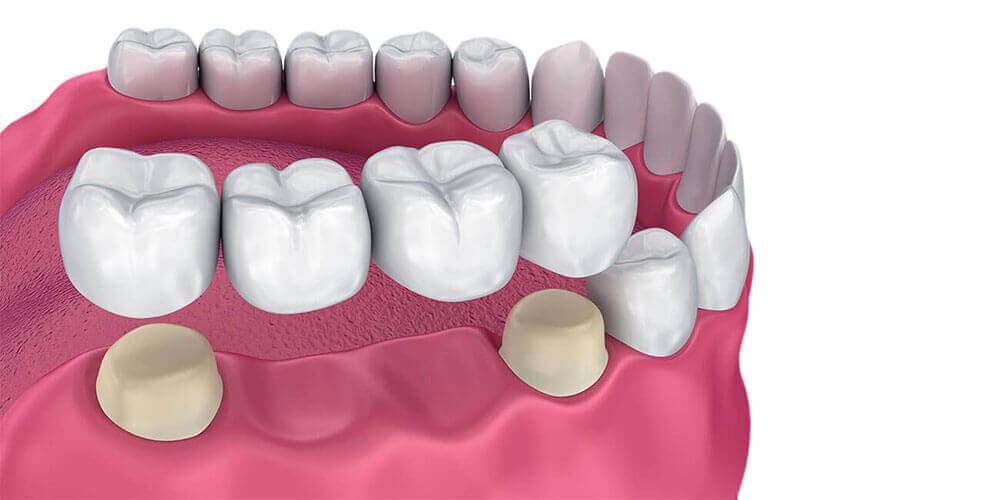 Dental Bridges Mississauga