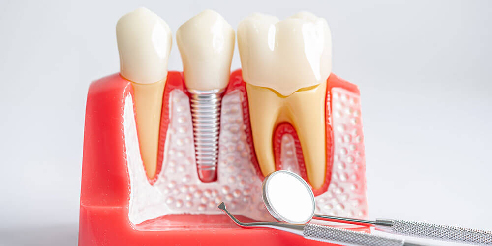 Dental Implants Mississauga